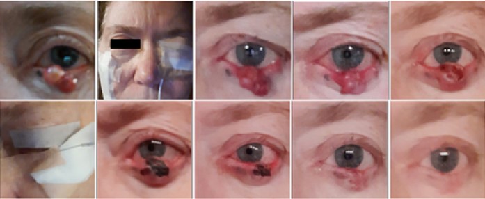 Progressive healing of Basal Cell Carcinoma