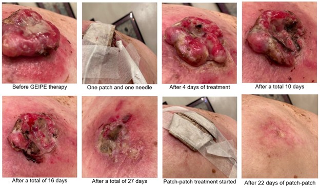 Carcinoma Patient in Southern California