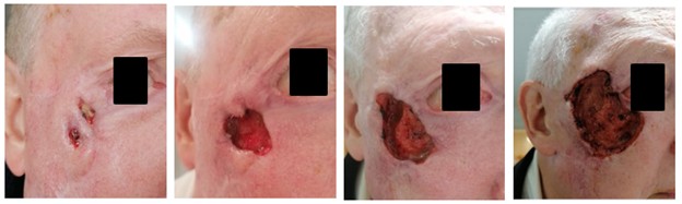 fungating tumor or ulcerating cancer